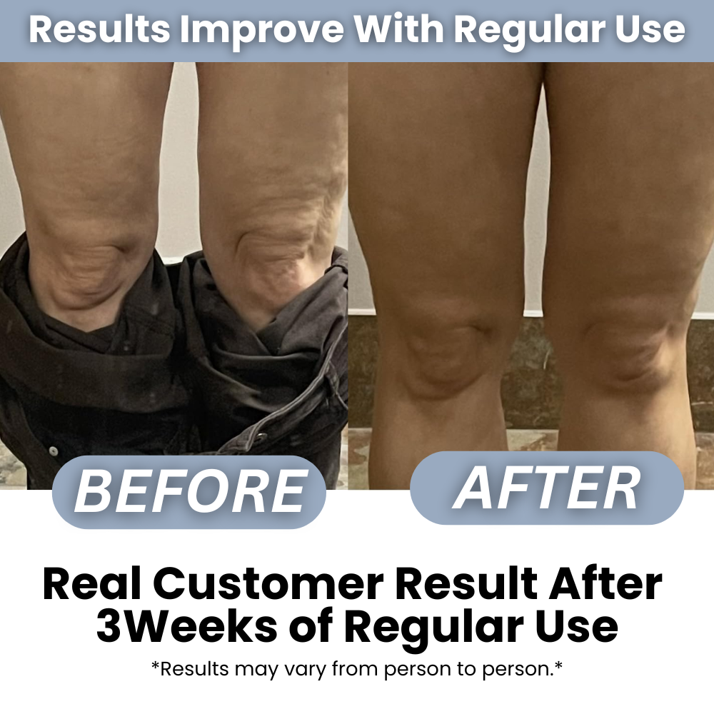 CelluGone™ - Anti Cellulite Roller + Massage Oil Kit