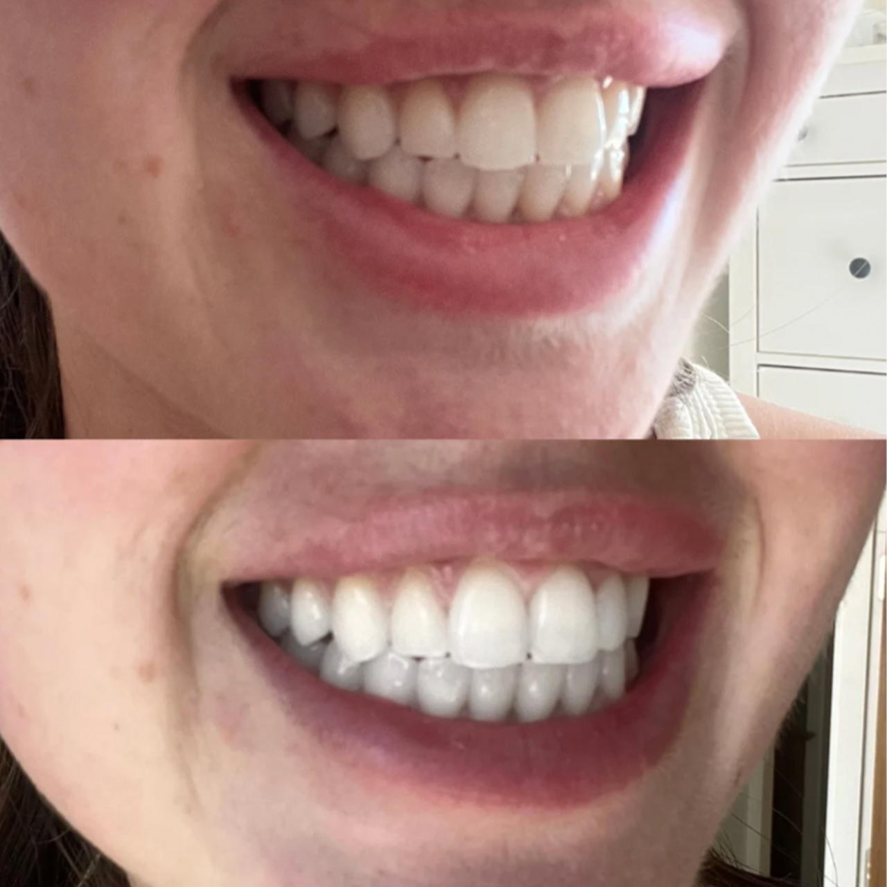 Teeth Whitening Strips