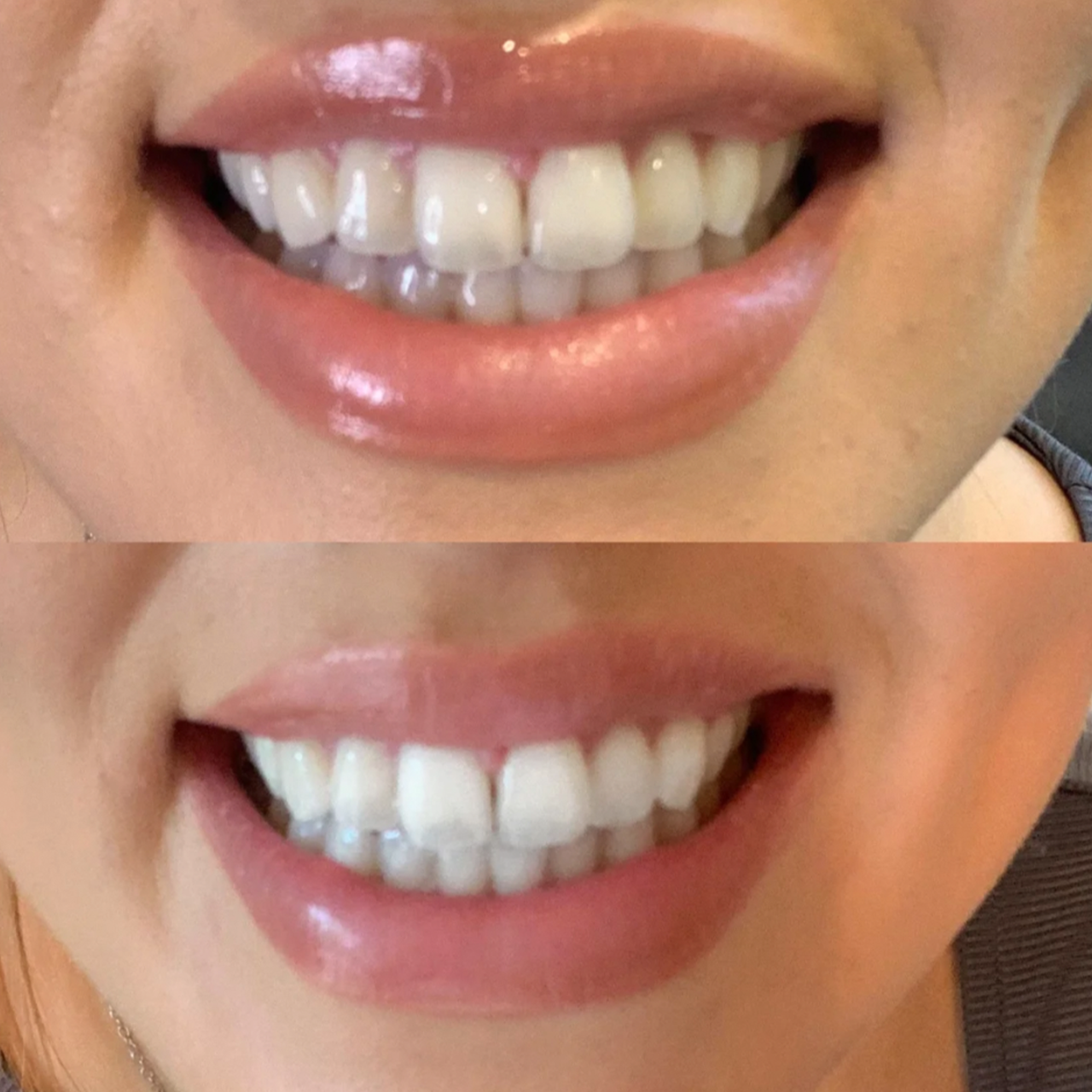 Teeth Whitening Strips